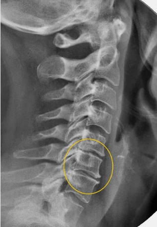 Остеохондроза на шийния гръбначен стълб върху x -ray