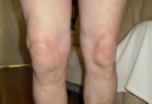 прояви на артроза на колянната става (1)