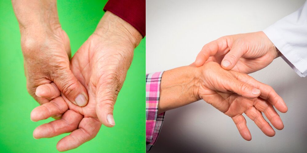 подуване и болки в болката са първите признаци на артрит на ръцете