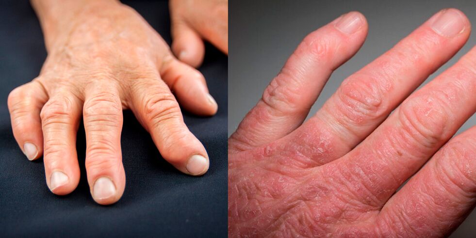 ревматоиден и псориатичен артрит на ръцете