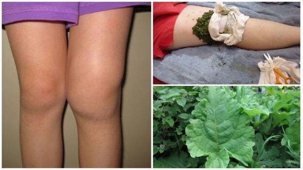 билков компрес за артроза на коляното
