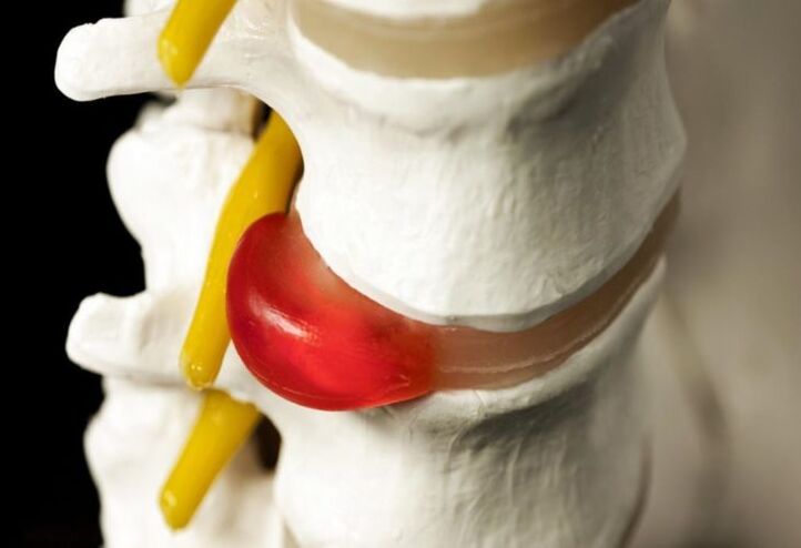гръбначна херния като причина за болка в лопатките